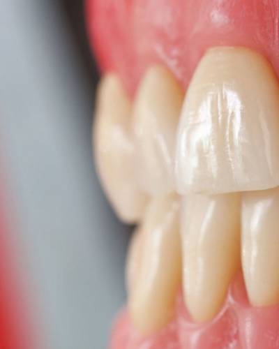 PMMA CAD/CAM